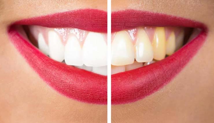 yellow teeth,remedies for yellow teeth,home remedies,beauty tips,teeth care tips