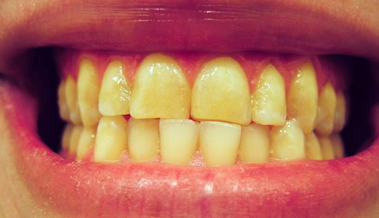 दातों के पीलेपन से छुटकारा दिलाएँगे ये उपाय, बिना खर्चे के बनाए इन्हें सुंदर