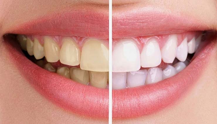 yellow teeth,remedies for yellow teeth,home remedies,beauty tips,teeth care tips