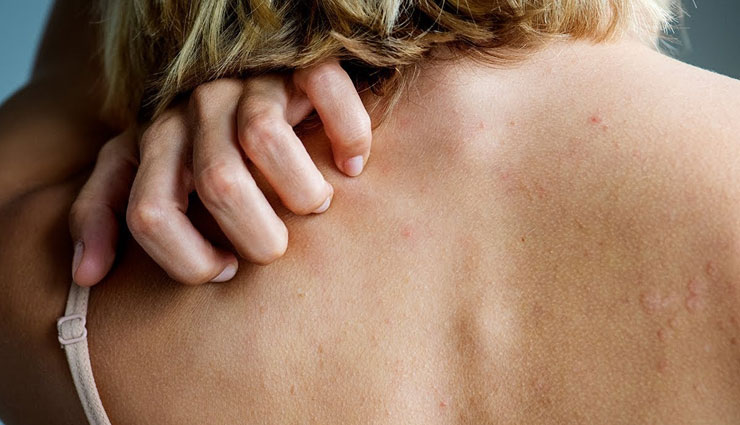 home remedies,home remedies for skin allergy,remedy to treat skin allergy instantly,Health tips