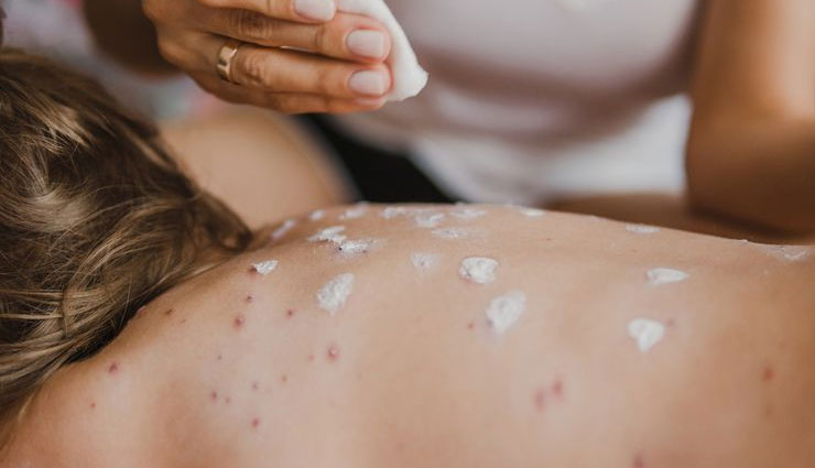 5 Home Remedies To Get Rid of Skin Allergies Instantly