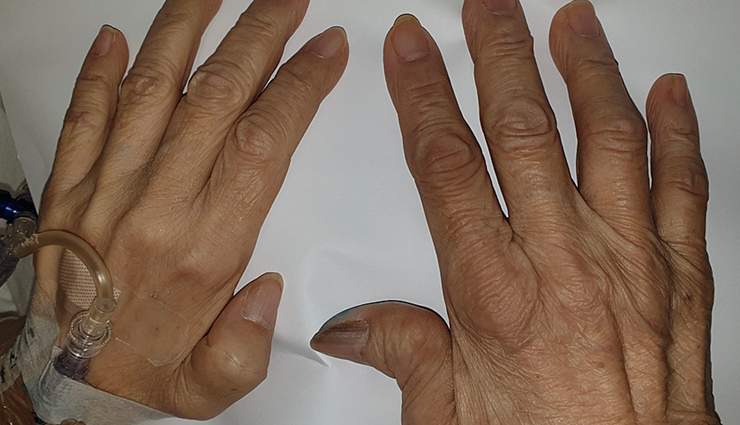 rheumatoid arthritis,measures to fight rheumatoid arthritis,Health tips,fitness tips