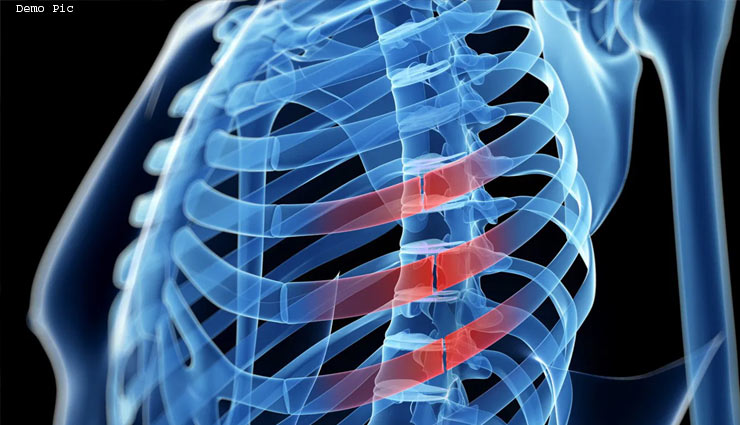 अचानक से टूटने लगी इस 20 वर्षीय लड़की की पसलियां, वजह जान डॉक्टर भी हुए हैरान