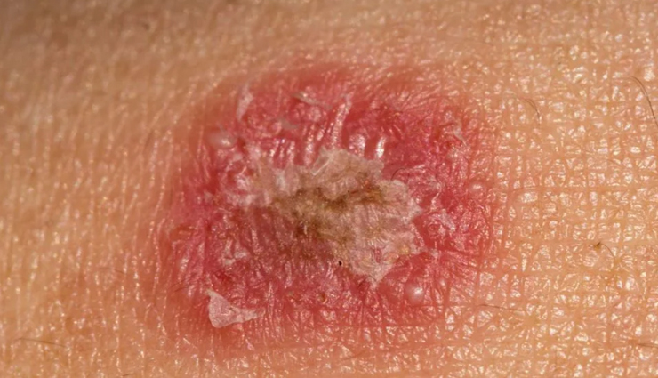 monsoon skin problems,skin issues during rainy season,common skin problems in monsoon,home remedies for monsoon skin problems,natural remedies for rainy season skin issues,getting rid of skin problems in the monsoon,monsoon skincare tips,treating skin problems during rainy season,monsoon skincare home remedies,healthy skin in the monsoon