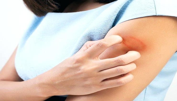 दाद से होने वाली खुजली को जड़ से मिटाए, ले इन घरेलू नुस्खों की मदद