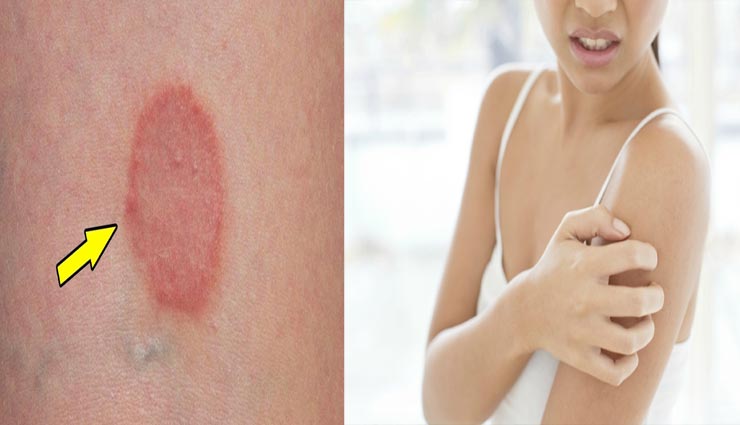 बदलते मौसम में दाद की समस्या सामान्य, टी ट्री ऑइल से दूर होगी यह परेशानी