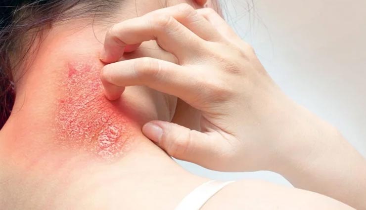 जड़ से मिटेगी दाद-खाज-खुजली की समस्या, जानें इस्तेमाल का तरीका