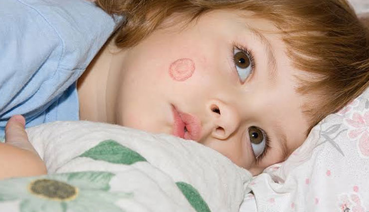5 Natural Ways To Treat Ringworm in Kids