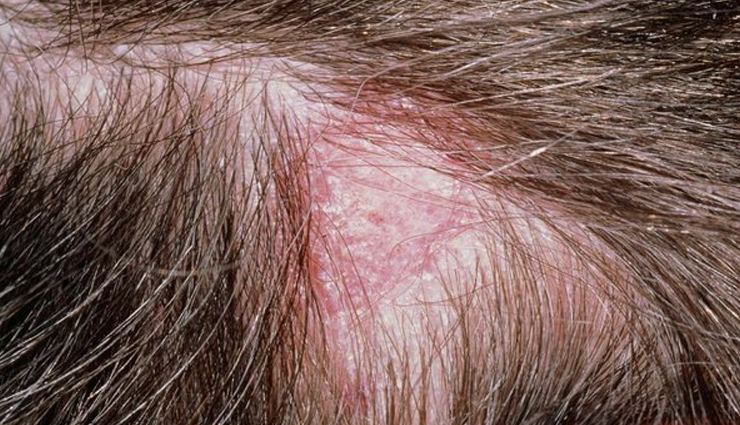 scalp scabs treatment,treating scabs on the scalp,get rid of scalp scabs,home remedies for scalp scabs,scalp care tips,scab removal methods,scalp health advice,healing scalp sores,natural remedies for scalp scabs,preventing scalp scabs