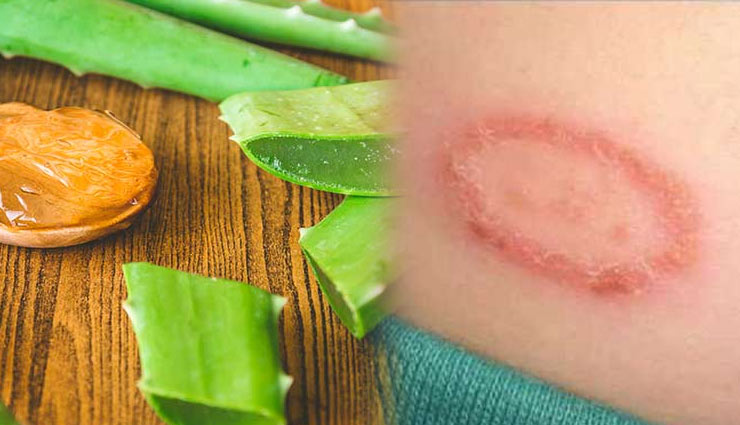 बारिश के दिनों में दाद की समस्या बनती है परेशानी, ये 3 उपाय दिलाएँगे आपको राहत 