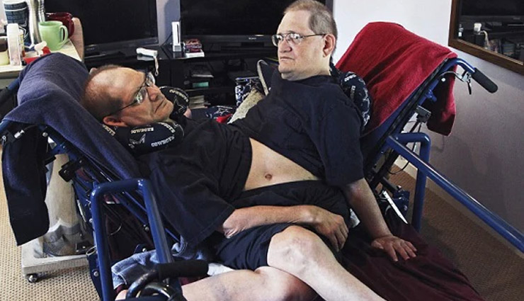 ronnie galyon,donnie,galyon,conjoined twins,ronnie and donnie gaylon die,conjoined twins record,weird news