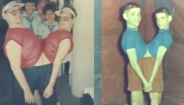 ronnie galyon,donnie,galyon,conjoined twins,ronnie and donnie gaylon die,conjoined twins record,weird news