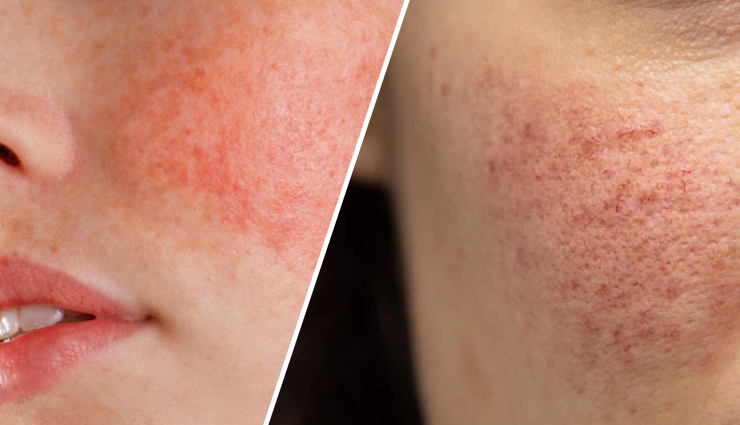 grape benefits for skin,grapes skincare advantages,grape skincare secrets,antioxidant-rich grapes for skin,grape anti-aging properties,hydrating benefits of grapes,grape-derived skincare solutions,natural skin brightening with grapes,grape-based uv protection,grapes for wound healing,collagen-boosting grapes,grapes for acne prevention,grape seed oil moisturization,resveratrol benefits for skin,grape skincare science,grapes for healthy skin,grapes for radiant complexion,grape skincare remedies,grapes for youthful-looking skin,grape skincare essentials