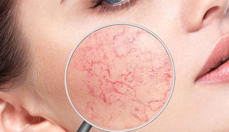 effective home remedies for rosacea,alleviate rosacea symptoms with home remedies,natural remedies for rosacea relief,home remedies to reduce rosacea redness,natural treatments for rosacea symptoms,alleviating rosacea with effective home remedies,home remedies for rosacea management,relieve rosacea symptoms naturally at home,home remedies to soothe rosacea flare-ups,holistic approaches to rosacea symptom relief