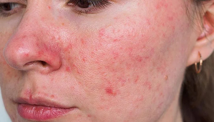 7 Home Remedies To Treat Rosacea on Face