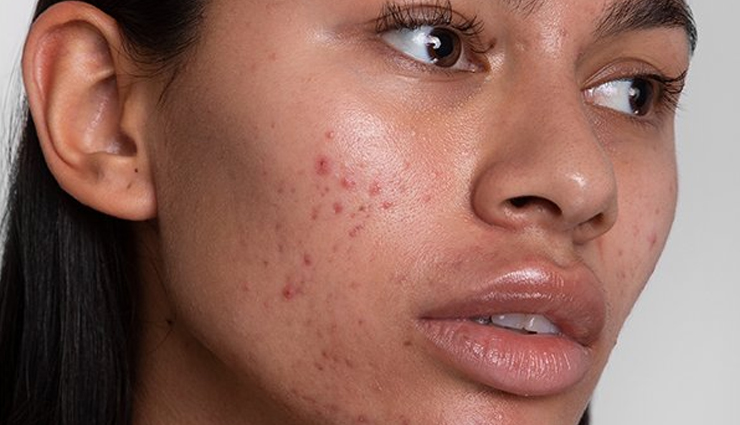 rosehip oil,beauty benefits of rosehip oil,skin care tips,beauty tips,rosehip oil for skin,rosehip oil uses