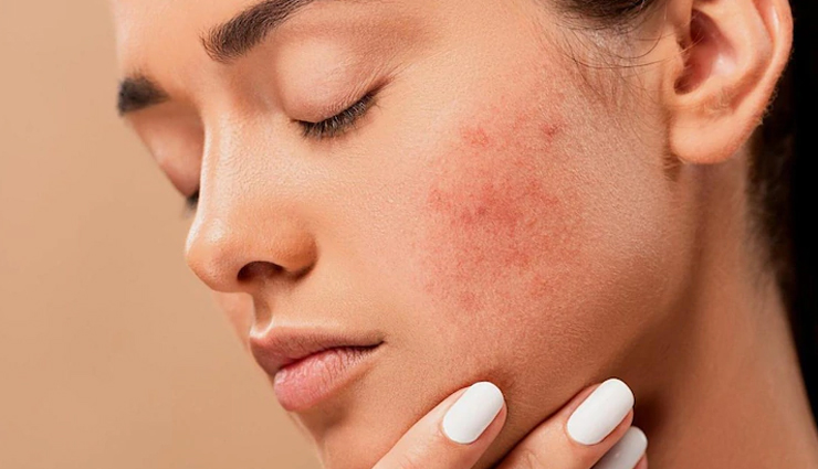 rosemary oil,beauty benefits of rosemary oil,rosemary oil for skin,rosemary oil for hair,beauty tips,skin care tips