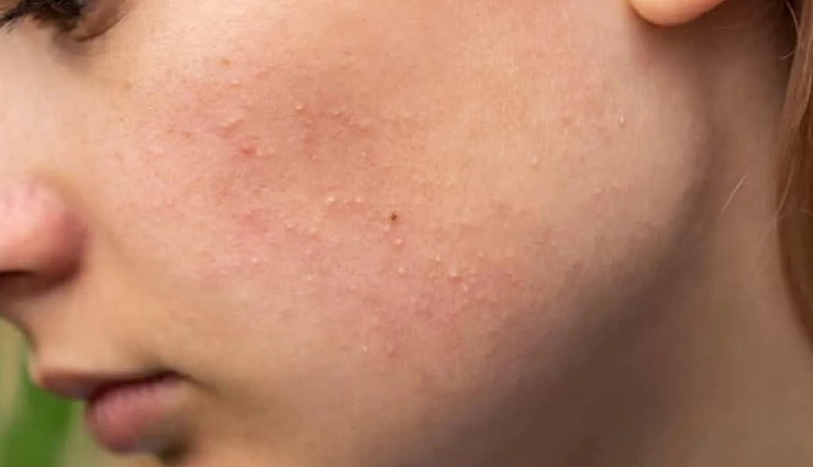 5 DIY Ways to Treat Rough Skin