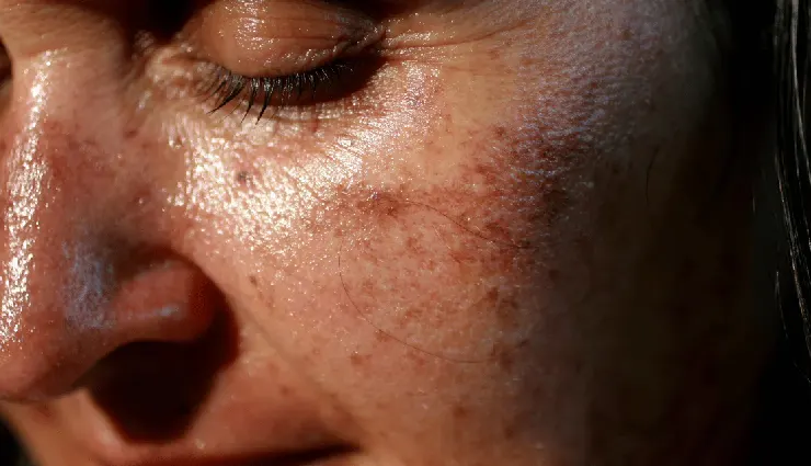 15 Foods That Ruin Your Skin