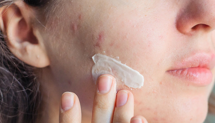 comedonal acne causes,treating comedonal acne,preventing comedonal acne,comedonal acne treatment options,how to manage comedonal acne,blackheads and whiteheads treatment,skincare for acne-prone skin,non-comedogenic skincare products,preventing clogged pores,healthy skincare practices