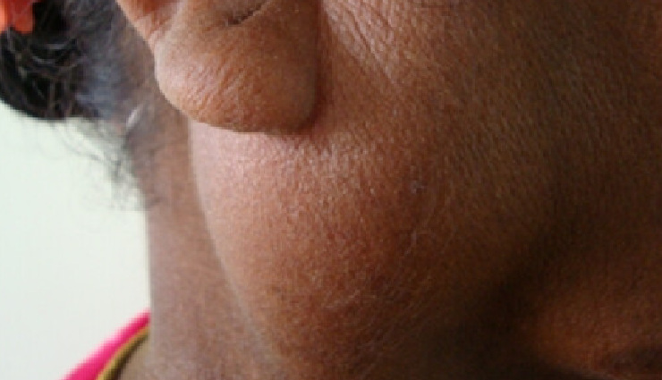 anaplastic thyroid cancer,small bowel adenocarcinoma,fibrolamellar hepatocellular carcinoma,gynaecological sarcoma,salivary gland cancer,thymoma,penile cancer,relapsed metastatic anal cancer,ocular melanoma