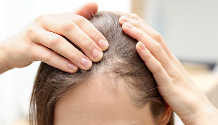 irritating scalp conditions in women,hair care tips,women hair care tips,beauty tips,hair loss,dandruff,head lice,eczema,psoriasis