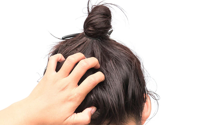 Look at Some Irritating Scalp Conditions in Women