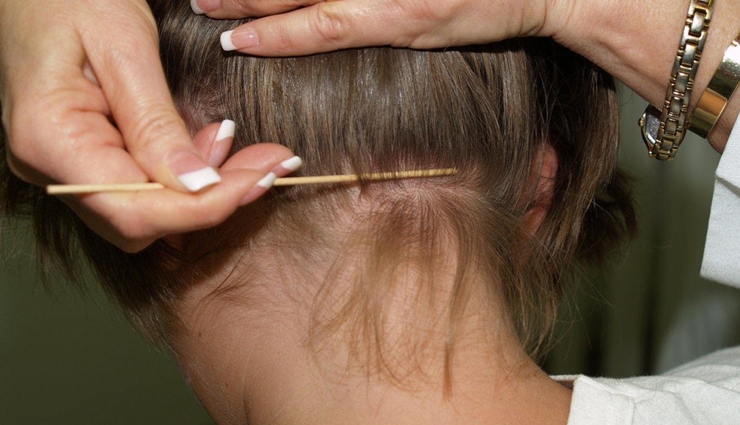 irritating scalp conditions in women,hair care tips,women hair care tips,beauty tips,hair loss,dandruff,head lice,eczema,psoriasis