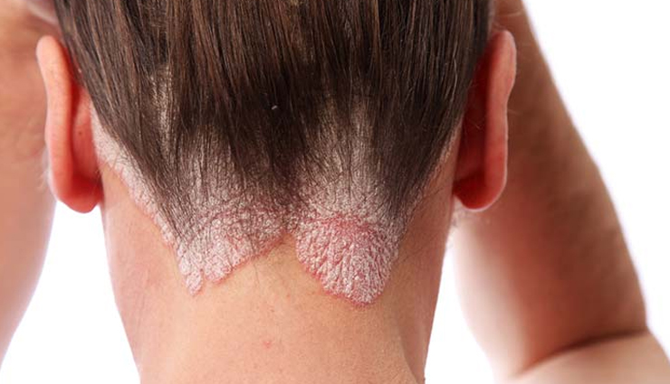 irritating scalp conditions in women,hair care tips,women hair care tips,beauty tips,hair loss,dandruff,head lice,eczema,psoriasis