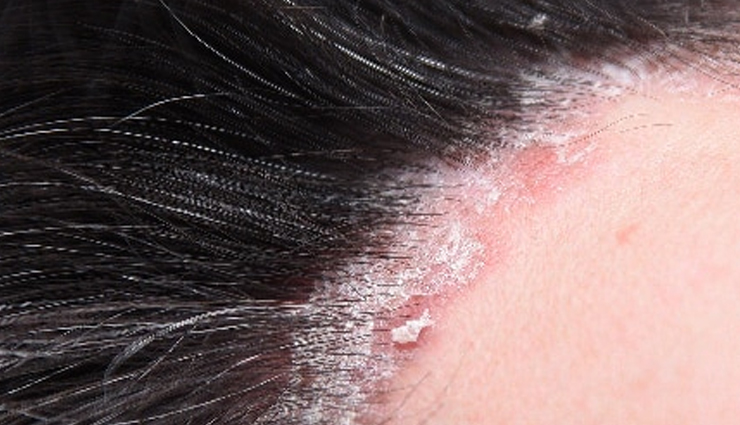 irritating scalp conditions in women,hair care tips,women hair care tips,beauty tips,hair loss,dandruff,head lice,eczema,psoriasis