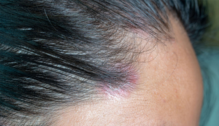 5 Home Remedies To Get Rid of Scalp Acne Quickly