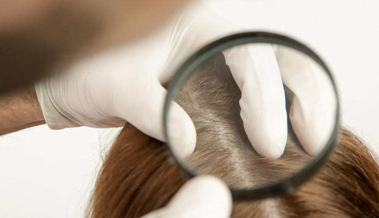 6 DIY Ways To Treat Scalp Acne Naturally