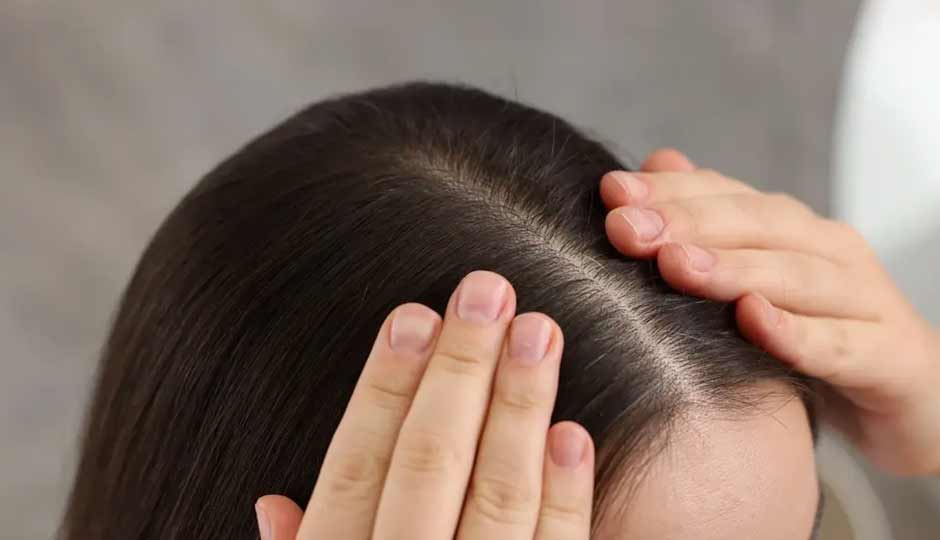 10 Home Remedies to Treat Scalp During Monsoon