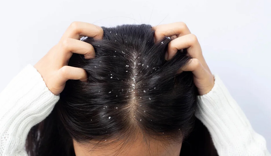6 Effective Home Remedies To Treat Scalp Infection