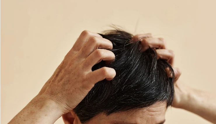 8 DIY Ways To Treat Scalp Irritation