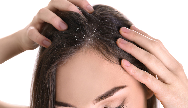 5 Foods You Must Eat To Get Rid of Scalp Psoriasis at Home