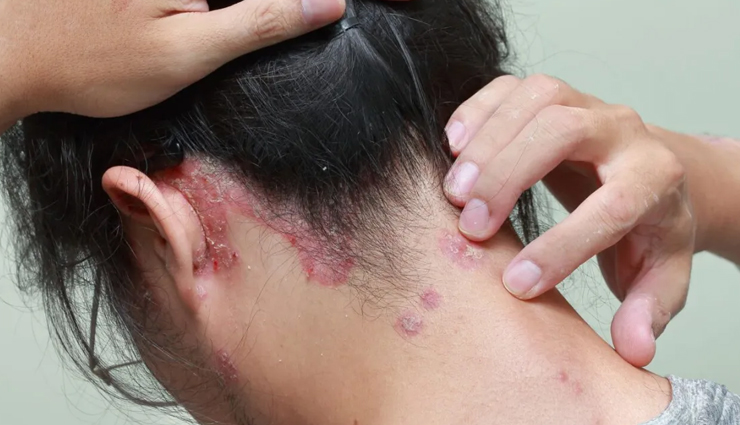 4 DIY Ways To Use Turmeric for Scalp Psoriasis