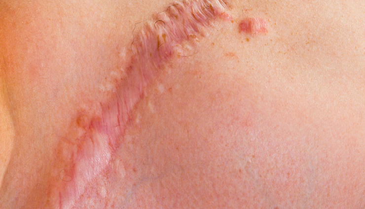 tea tree oil benefits for skin,natural skin care with tea tree oil,antimicrobial properties of tea tree oil for skin,acne treatment with tea tree oil,tea tree oil for oily skin,soothing effects of tea tree oil on skin,tea tree oil for eczema and psoriasis,anti-inflammatory benefits of tea tree oil on skin,tea tree oil for anti-aging and wrinkles,tea tree oil for dark spots and hyperpigmentation