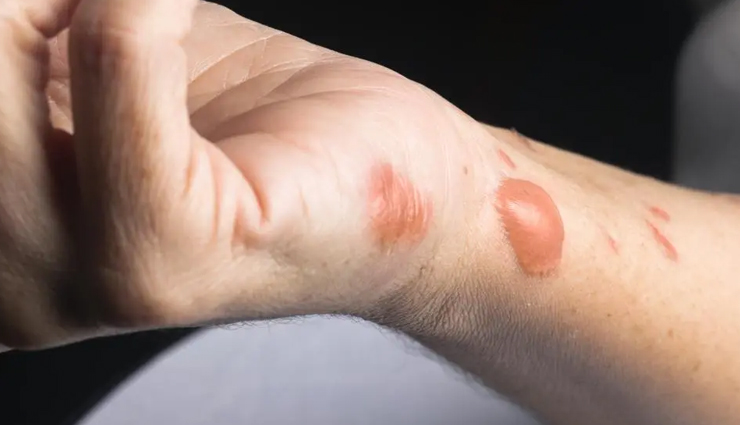 4 Tried Home Remedies To Treat Burn Marks and Scars
