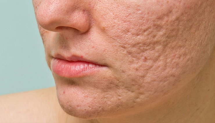 7 Effective Home Remedies To Help You Get Rid of Scars