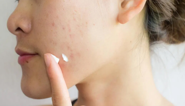 types of scars,treating scars,tips to treat scars,beauty tips,beauty hacks,scars treatment