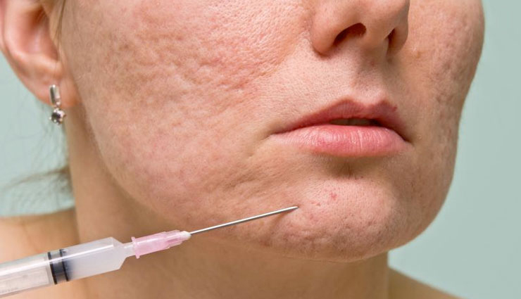 types of scars,treating scars,tips to treat scars,beauty tips,beauty hacks,scars treatment