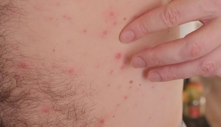 chickenpox,chickenpox treatment,chickenpox treatment at home,remedies to treat chickenpox,Health,Health tips