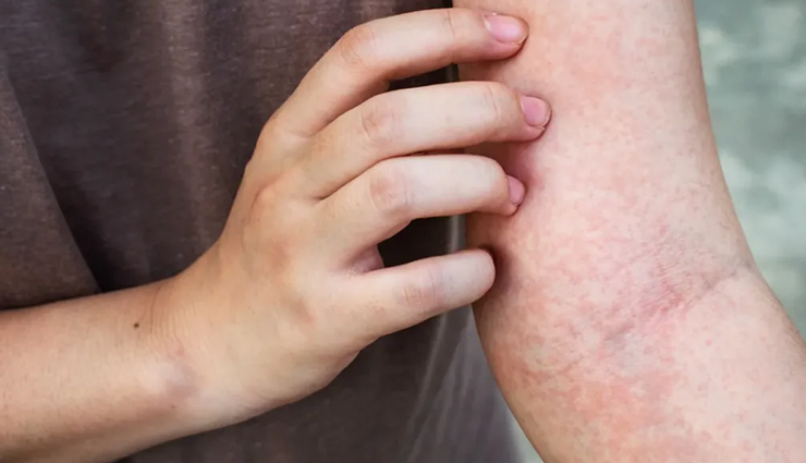 skin infection,bad habits for skin,skin health,skin care mistakes,prevent skin infection,skin hygiene,unhealthy skin habits,skin infection causes,protect skin from infection,skin wellness tips
