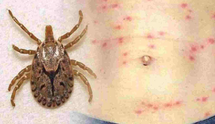 राजस्थान की परेशानी बढ़ा रहा स्क्रब टाइफस, कोरोना के समान हैं इसके लक्षण