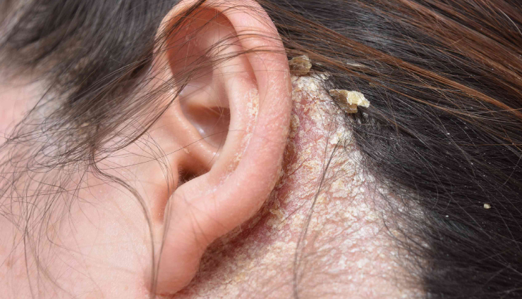 10 Natural Remedies To Manage Seborrheic Dermatitis