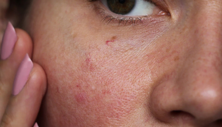 DIY:  Soothing Chamomile and Green Tea Face Pack for Sensitive Skin