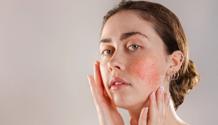 10 Home Remedies To Treat Sensitive Skin During Monsoon