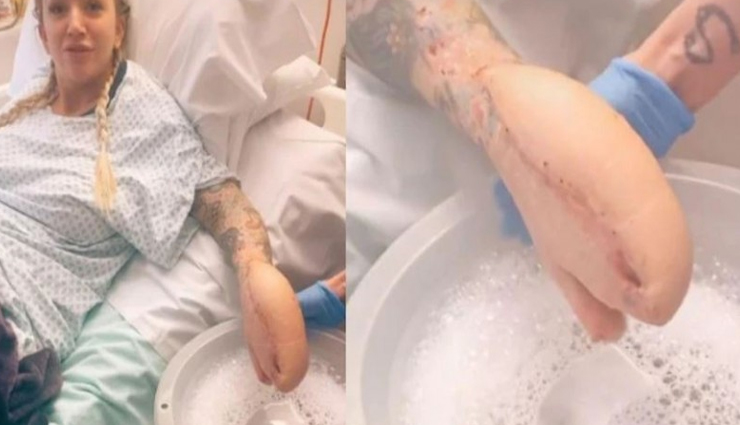 महिला को हुई अनोखी बीमारी जिसमें शार्क मछली जैसा दिखने लगा हाथ 