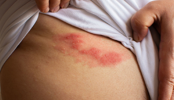 10 Home Remedies To Treat Shingles